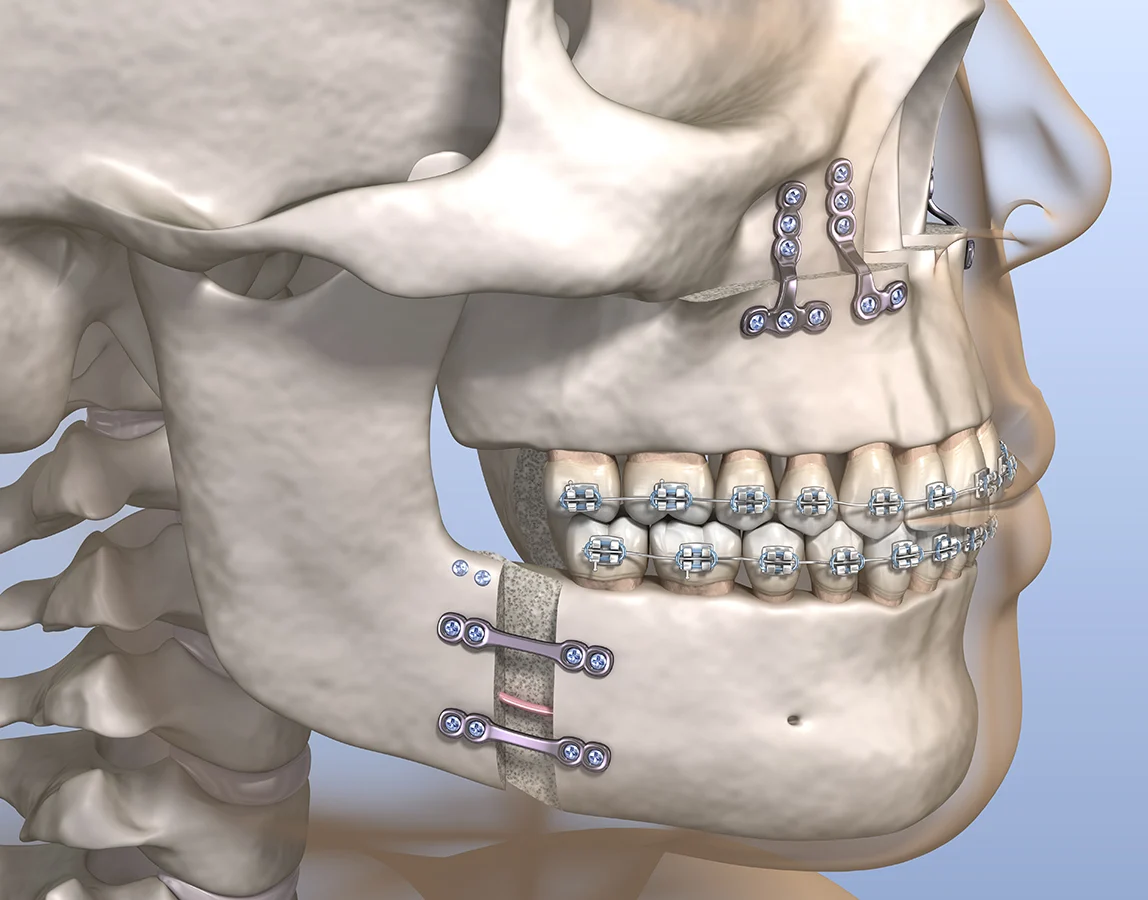 MAXILLOFACIAL SURGERY