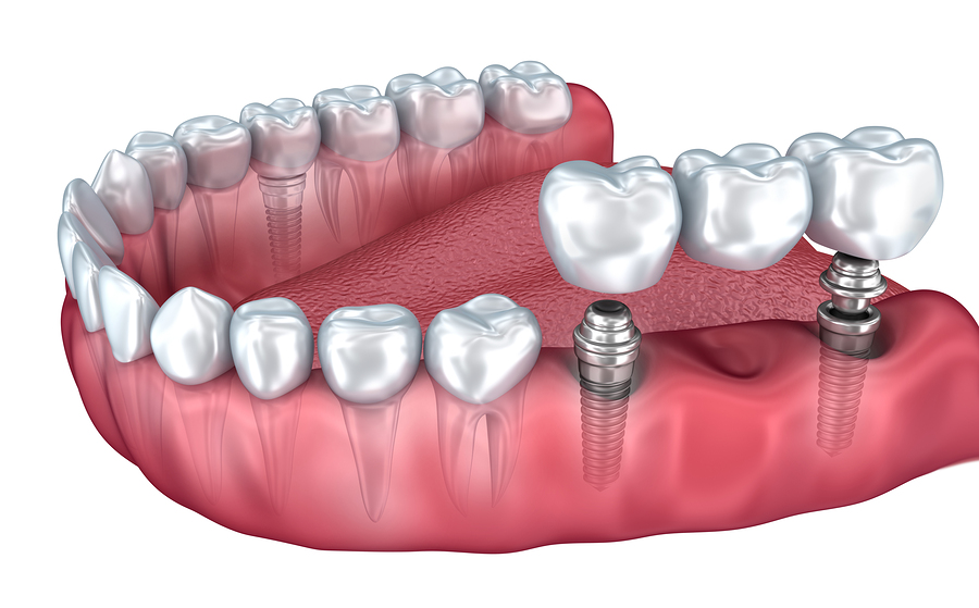 PROSTHODONTIC TREATMENT