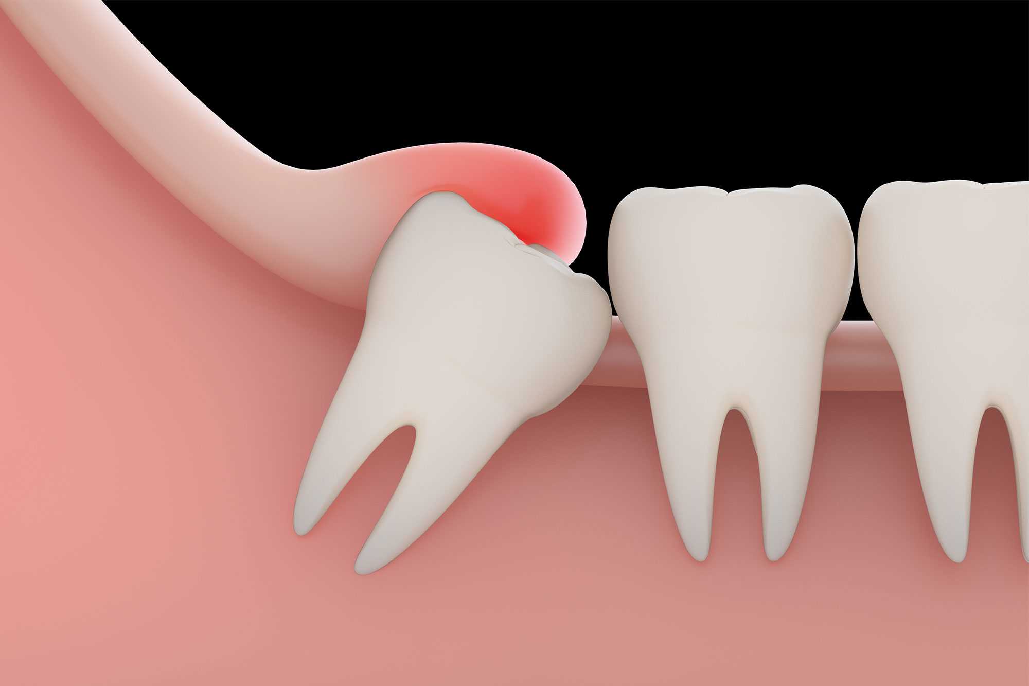 WISDOM TOOTH EXTRACTION