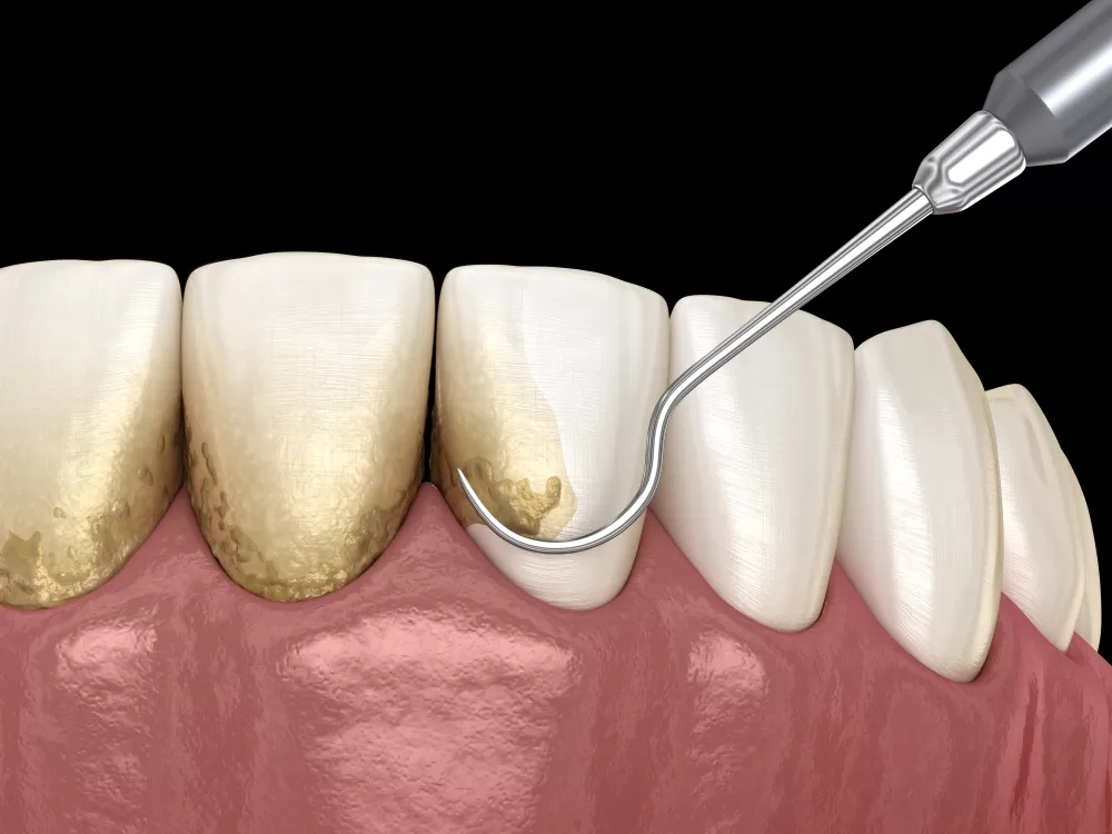 Periodontal Therapy