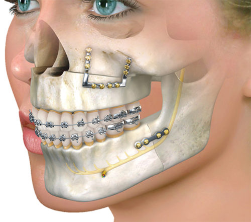 MAXILLOFACIAL SURGERY