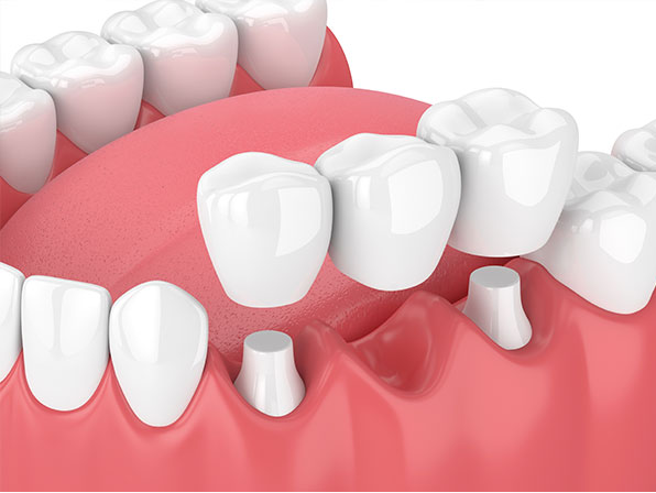 PROSTHODONTIC TREATMENT