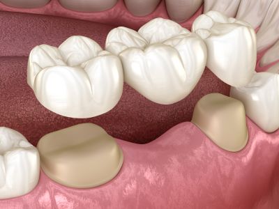 DENTAL CROWN AND BRIDGE IMPLANT