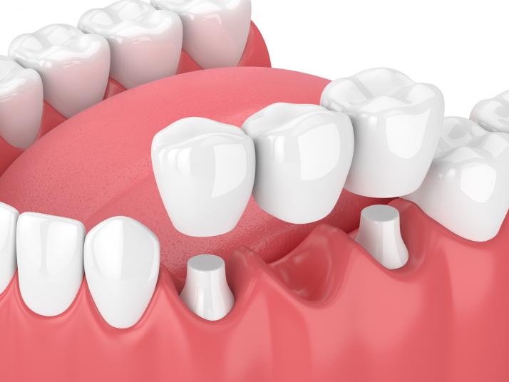 DENTAL CROWN AND BRIDGE IMPLANT