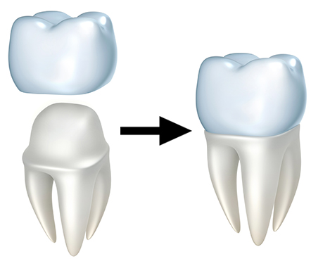 DENTAL CROWN