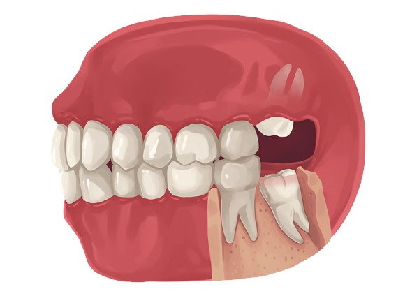 WISDOM TOOTH EXTRACTION